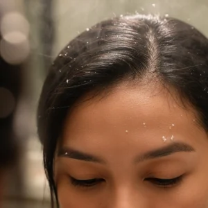 Dandruff Prevention Tips: Simple Habits That Keep Flakes Away
